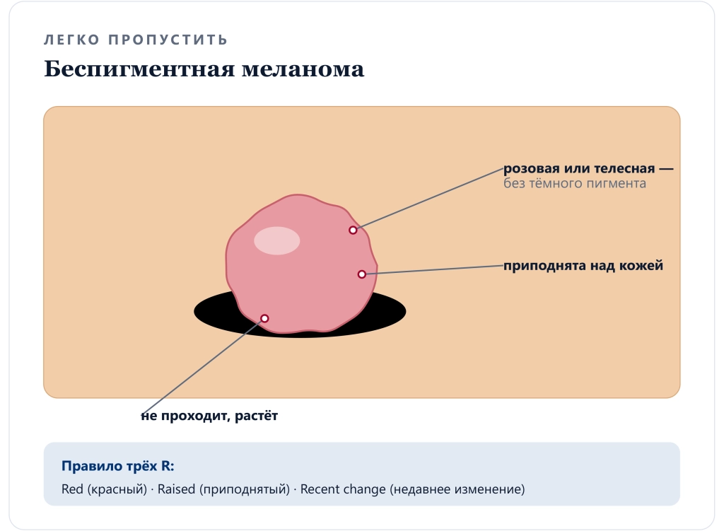 Беспигментная (амеланотическая) меланома: розовый узелок без тёмного пигмента