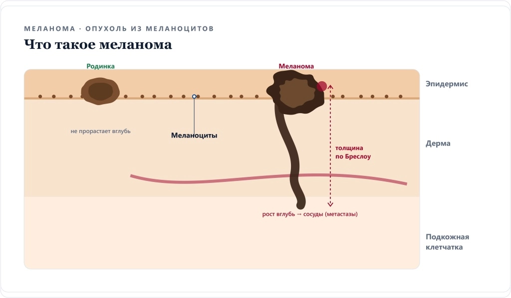 Строение меланомы: опухоль из меланоцитов прорастает вглубь кожи, толщина по Бреслоу