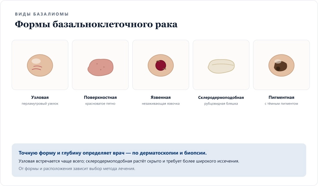 Формы базалиомы: узловая, поверхностная, язвенная, склеродермоподобная и пигментная