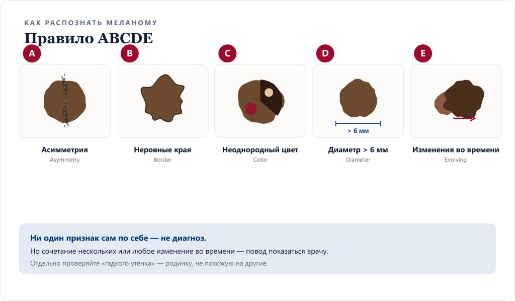 Правило ABCDE для самообследования родинок: асимметрия, неровные края, неоднородный цвет, диаметр больше 6 мм, изменения во времени