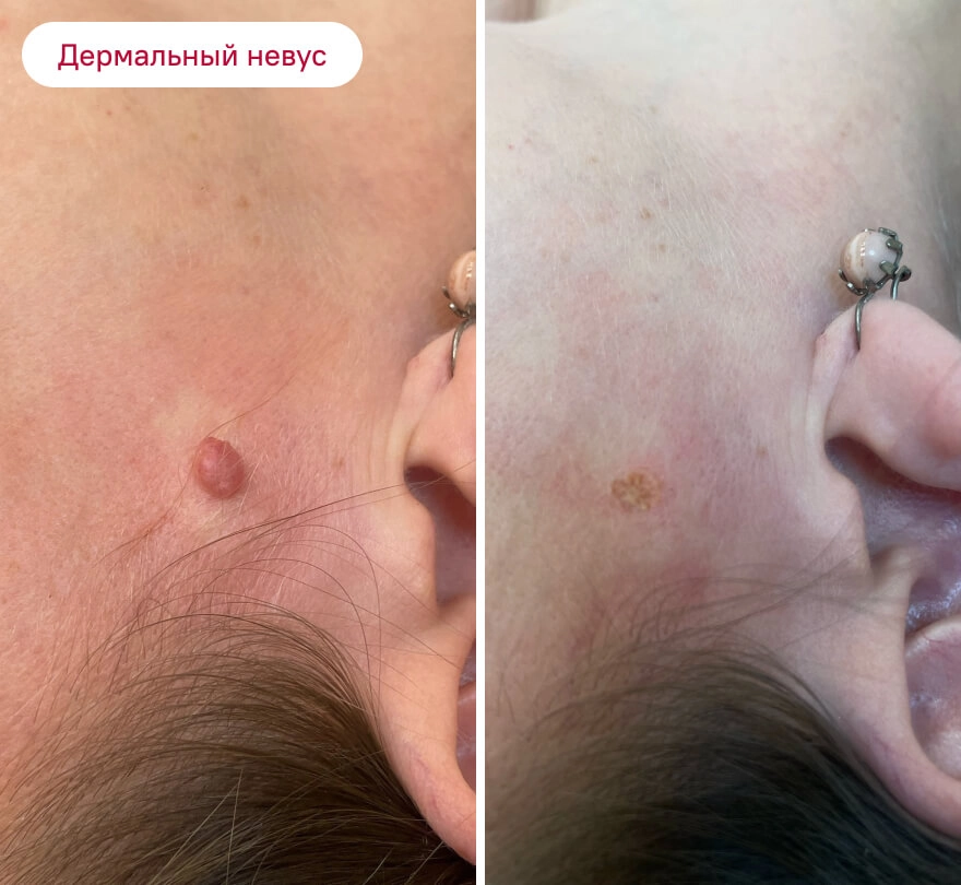 До и после: Дермальный невус