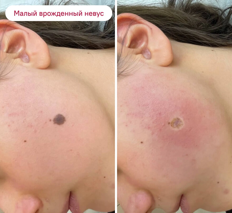 До и после: Малый врождённый невус