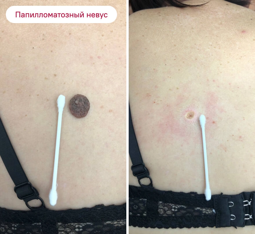 До и после: Папилломатозный невус